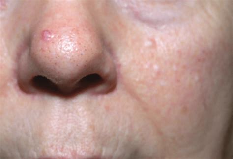 Characteristic Multiple Dome Shaped Papules On The Nose And Cheek Of A