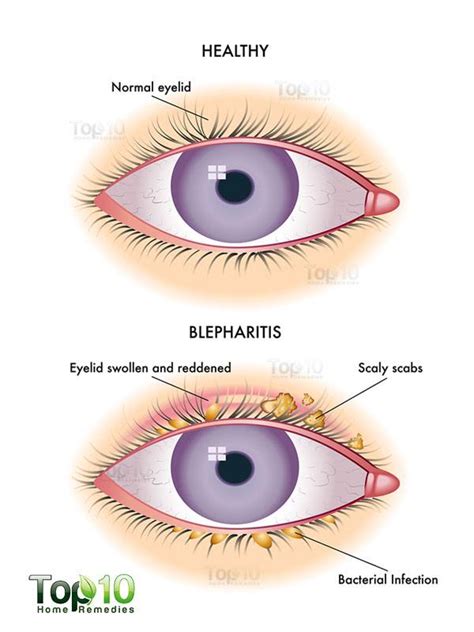 Home Remedies For Blepharitis Eyelid Inflammation Top 10 Home Remedies