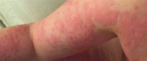 Florida Woman Allergic To Own Sweat Tears Details Her Ordeal With Rare