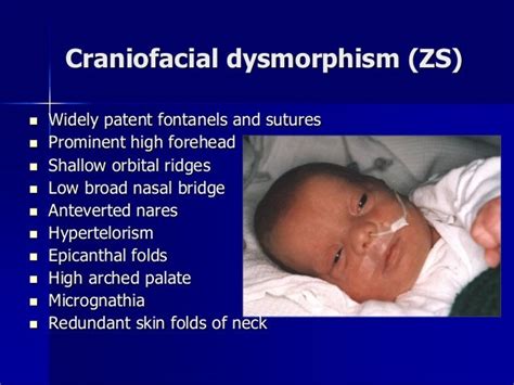 Dysmyelination Syndromes