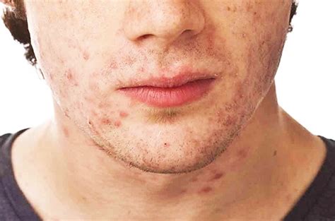 Acne Fulminans A Severe Form Of Acne Mostly Seen In Male Teens