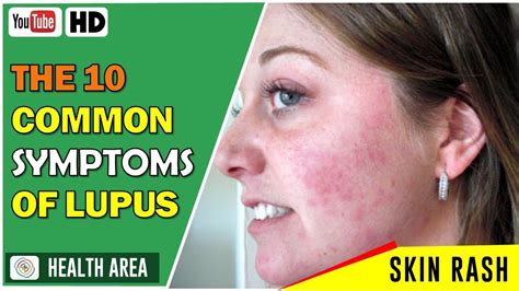 Lupus Types And Symptoms