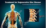 Pictures of Degenerative Disc Disease Doctor