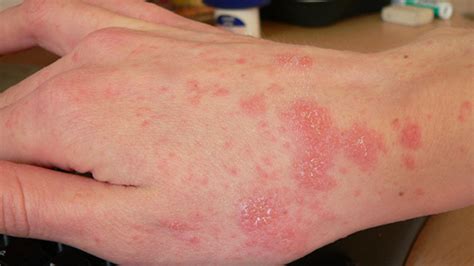 View 35 Skin Diseases Early Stage Eczema Psoriasis