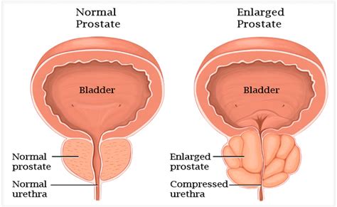 Enlarged Prostate Causes Symptoms And Treatments Prosman