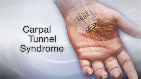 Apa Itu Carpal Tunnel Syndrome Tips Dan Fakta Unik Menarik