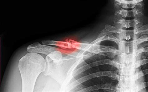 Clavicle Fractures Gregory Nicholson Md Gregory Nicholson Md