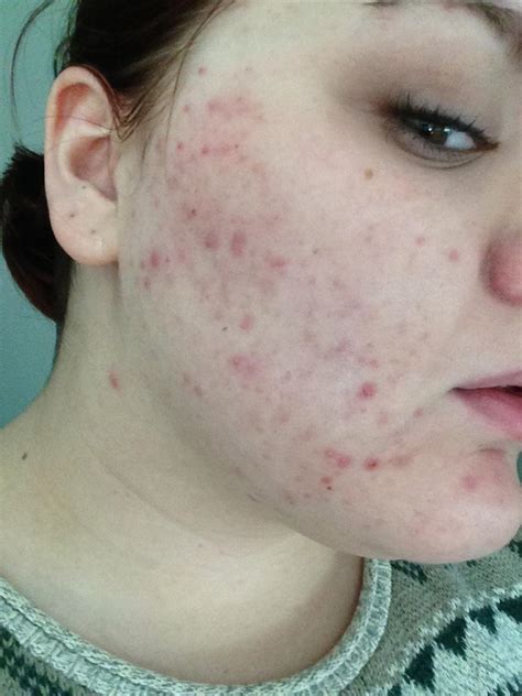 Sudden Adult Acne Pcos Hormonal Acne Forum