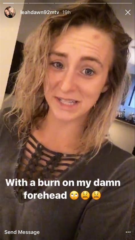 Teen Mom 2 Leah Messer Shows Off Painful Head Injury Is She Ok