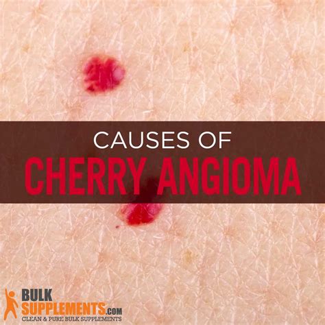 Cherry Angioma Characteristics Causes And Treatment Bulksupplements