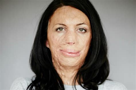 How Burn Victim And Cover Girl Turia Pitt Changed The Face Of Beauty