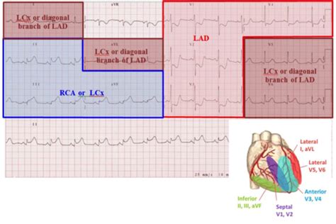 Relationship Of 12 Lead Ecg To Coronary Artery Anatomy Flashcards Quizlet