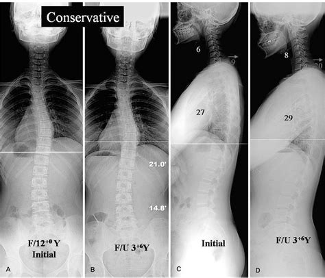 Degree Scoliosis Cervical Curve