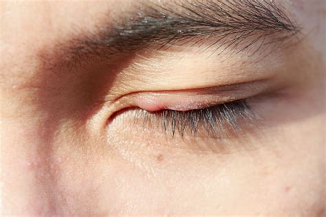 How We Examine A Chalazion Eyelid Lump To Figure Out What To Do