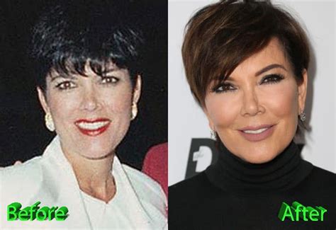 Kris Jenner Before And After Plastic Surgery Pics