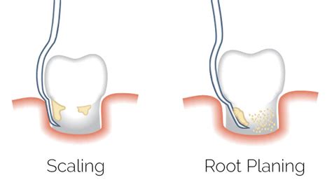 Scaling And Root Planing Cliffcrest Dental