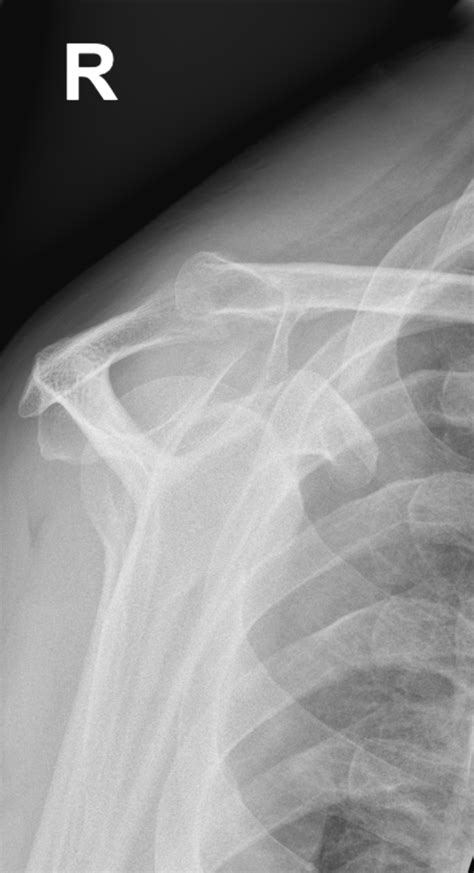 Clavicle Fracture Image