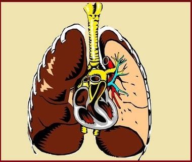 Elle se compose de deux feuillets : Cancer de la plèvre des poumons (mésothéliome pleural)