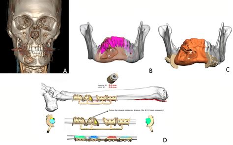 Frontiers Mandibular Reconstruction With Fibula Flap And Dental