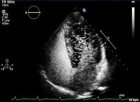 A Cardiac Diagnosis By Contrast Echocardiography Heart