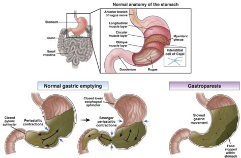 Gastroparesis Clinical Gastroenterology And Hepatology