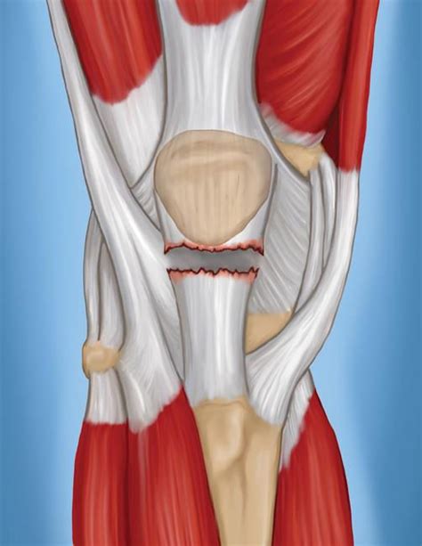 Common Knee Injuries Acme Spine And Orthopedics
