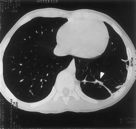 Figure 2 Ct Scan Of The Lung Bases Of A Boy With Leukemia And