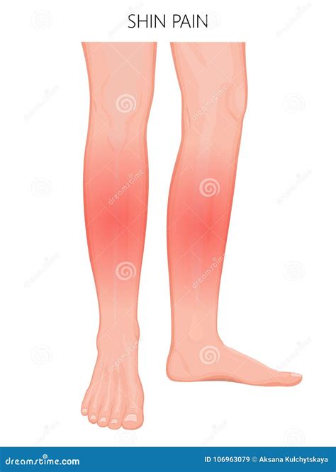 Bone Fractureshin Pain 09 Stock Vector Illustration Of Human 106963079