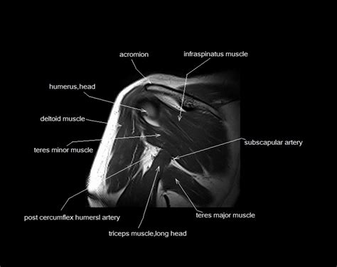 Mri Shoulder Anatomy Shoulder Coronal Anatomy Free Cross Sectional