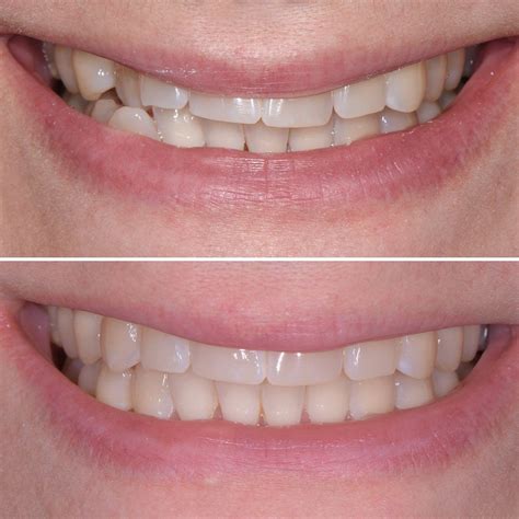 A Straight Smile Is The Best Smile 🤩 Invisalign Created This Beautiful Transformation And We
