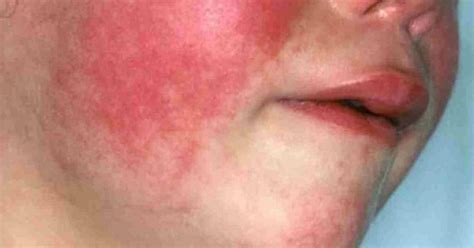 Scarlet Fever Is Making A Comeback And These Are The Warning Signs