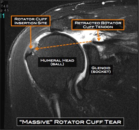 Shoulder Surgery Austin Tx Rotator Cuff Repair Cedar Park Round Rock