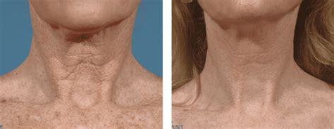 Neck Before And After San Juan Capistrano Ca Hk Dermatology