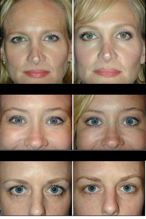 How do i know if i need an eyelid lift (blepharoplasty) combined with my brow lift to rejuvenate my eyes? Before you go under the knife for sagging eyebrows, Botox ...