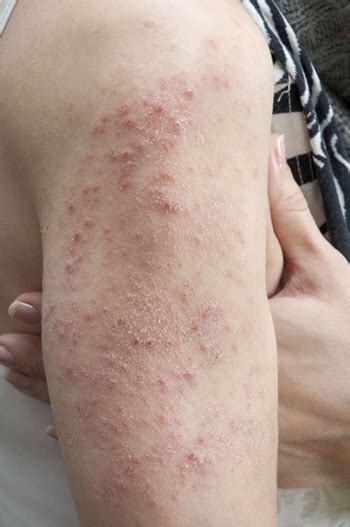 Contact Dermatitis Outbreak News Today