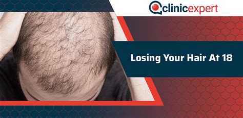 losing your hair at 18 clinicexpert