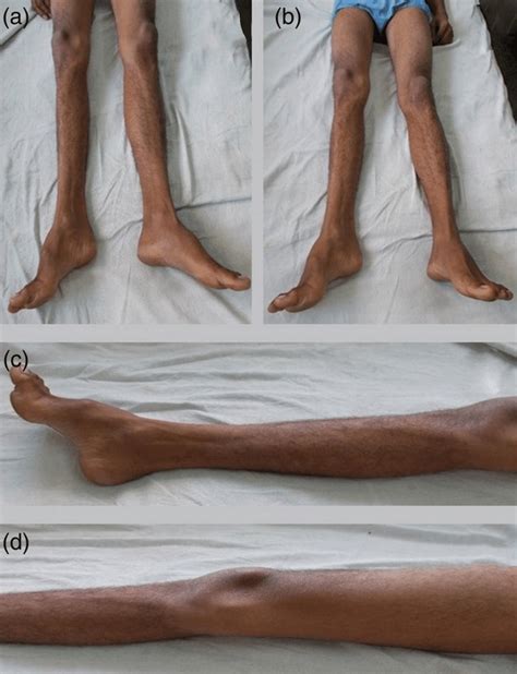 The Figure Of Lower Limbs Is Showing Atrophy Of Subcutaneous Tissue And