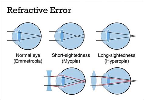 Eye Refractive Errors Symptoms Diagnosis And Treatment