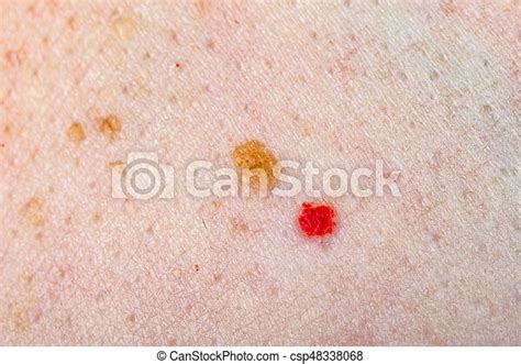 Nevus And Cherry Angioma On Human Skin Close Up Photo Of Nevus And