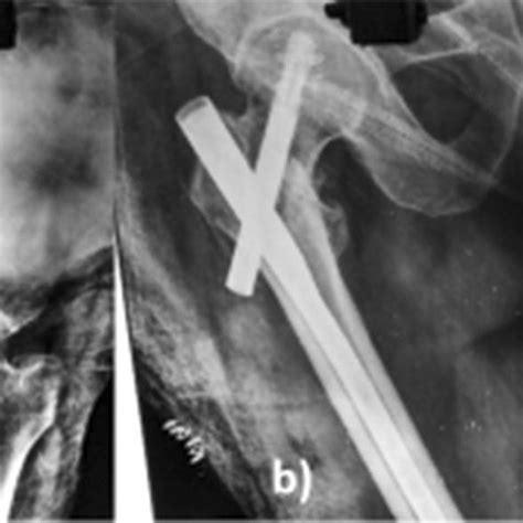 Pdf Comparison Of Radiological And Functional Outcome Of Unstable