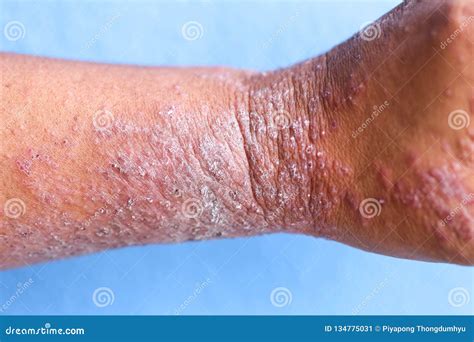 Skin Allergy Types Seeds Yonsei Ac Kr