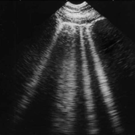 Pdf A Lines And B Lines Lung Ultrasound As A Bedside Tool For