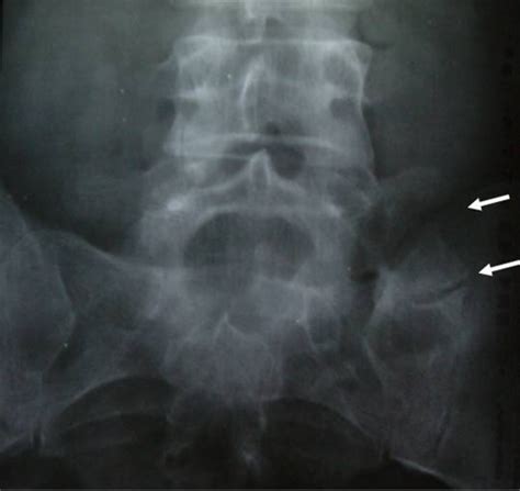 Anteroposterior Radiograph Of The Lumbar Spine Showing Open I