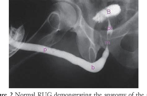 Figure 1 From Imaging Of Urethral Stricture Disease Semantic Scholar