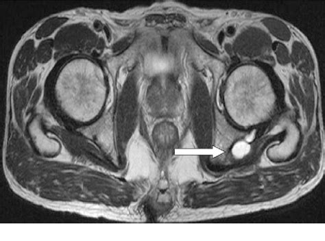 Figure 3 From A Paralabral Cyst Of The Hip Joint Causing Sciatica Case
