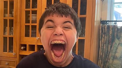 Midwest Teen Breaks The Record For Largest Mouth Gape Watch