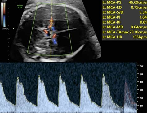 Acquisition Of Mca Doppler Flow Note The Use Of The Fetal Suture As A