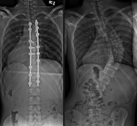 Pediatric Idiopathic Scoliosis Diagnosis And Management Physician