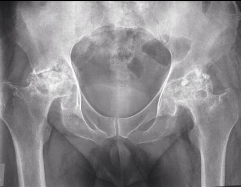 Avascular Necrosis Of Hips