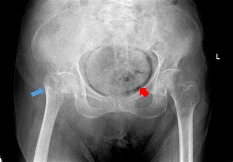 an unusual pelvis radiograph the bmj